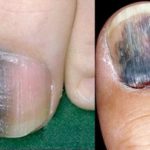 На ногте большого пальца ноги образовалось черное пятно: что делать?