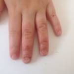 Кожные заболевания на пальцах рук: фото и названия