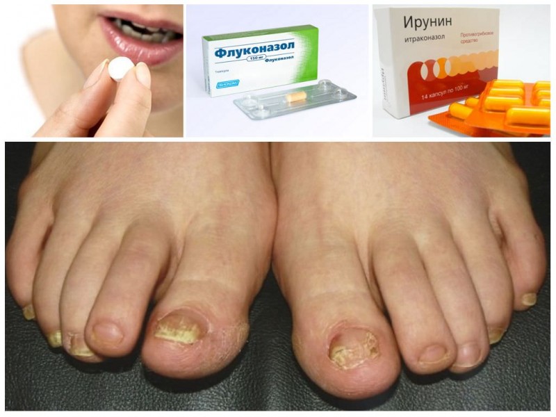 Чего боится грибок ногтей - самые эффективные медикаментозные и народные средства лечения