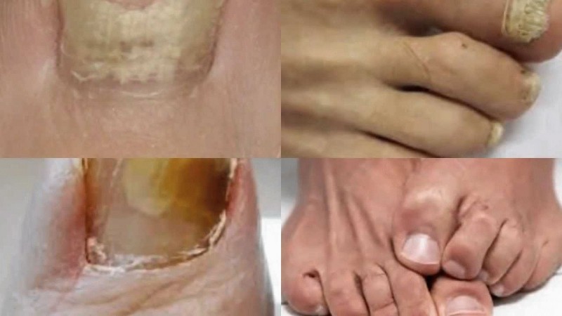 Виды грибка на ногах и лечение