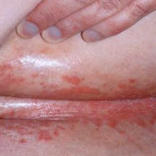 Микотические поражения кожи и слизистых оболочек