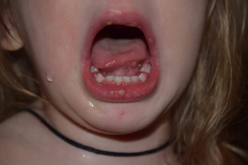 Как лечить шишку под языком