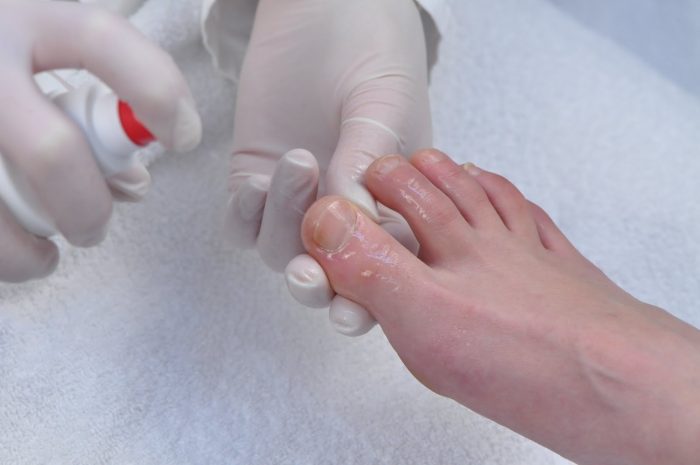 Лечение грибка ногтей на ногах хозяйственным мылом