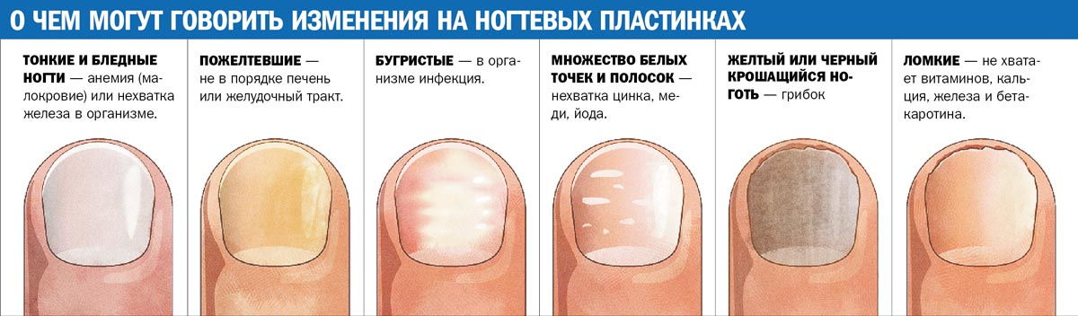 Ноготь на ноге пожелтел и стал толще причины и лечение