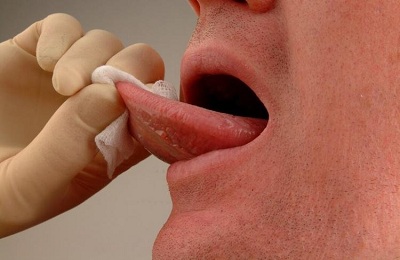 Подробно о способах лечения папиллом в полости рта