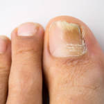 Может ли грибок ногтей перейти на кожу ног и рук?