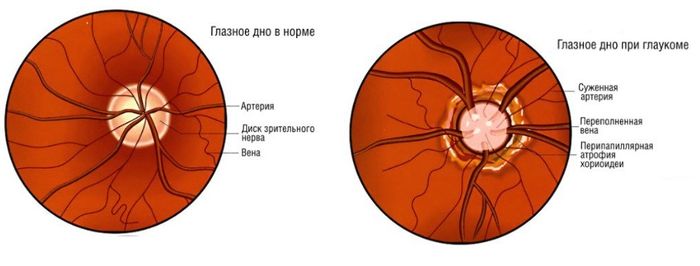 Глазное дно при глаукоме