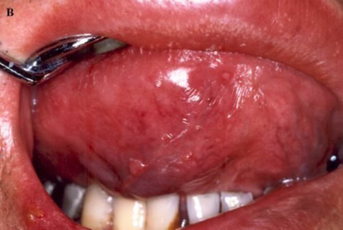 Как лечить шишку под языком