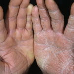 Грибковые заболевания кожи: фото, симптомы и лечение микоза