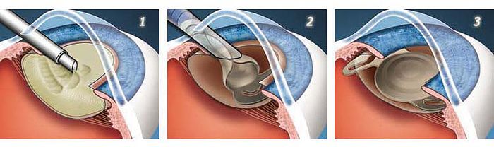 Факоэмульсификация катаракты 