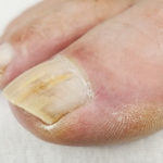Почему болит большой палец на ноге около ногтя: причины и лечение
