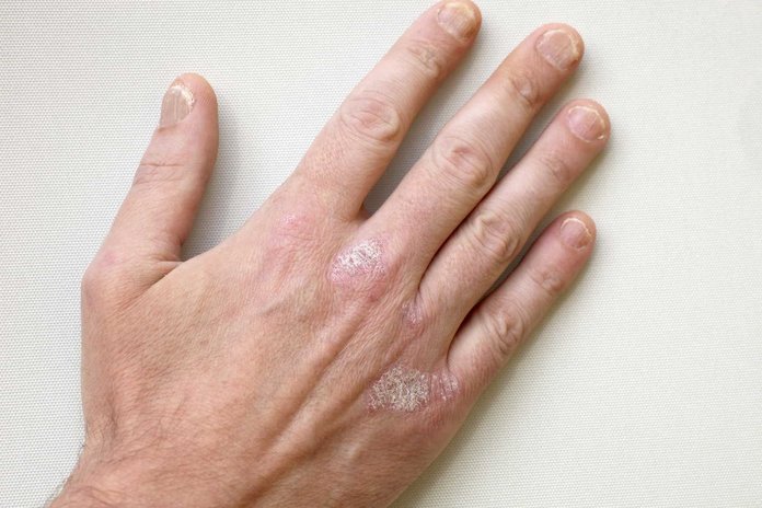 Симптомы и лечение псориаза пальцев рук