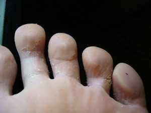 При образовании грибка ногтя на большом пальце ноги лечение какого рода применить