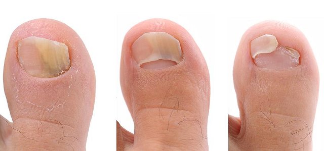 Чего боится грибок ногтей - самые эффективные медикаментозные и народные средства лечения