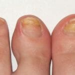 Почему желтеют ногти на ногах: причины и лечение