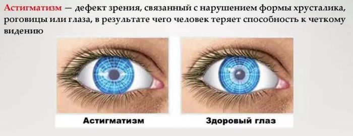 Заболевание глаз астигматизм