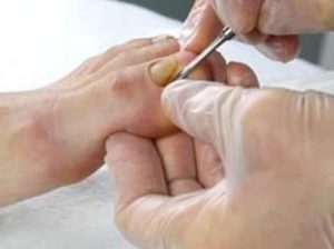 Анализ на грибок ногтей и кожи виды обследований, как проводятся