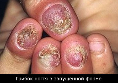 Как вылечить грибок на ногтях
