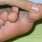 Микоз между пальцами ног: чем лечить грибок?