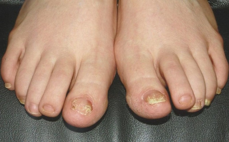 Можно ли убить грибок ногтей доместосом