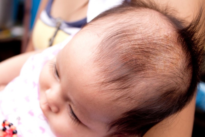 Псориаз волосистой части головы особенности диагностики и терапии