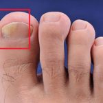 Как вылечить грибок ногтей на ногах быстро при запущенной форме?