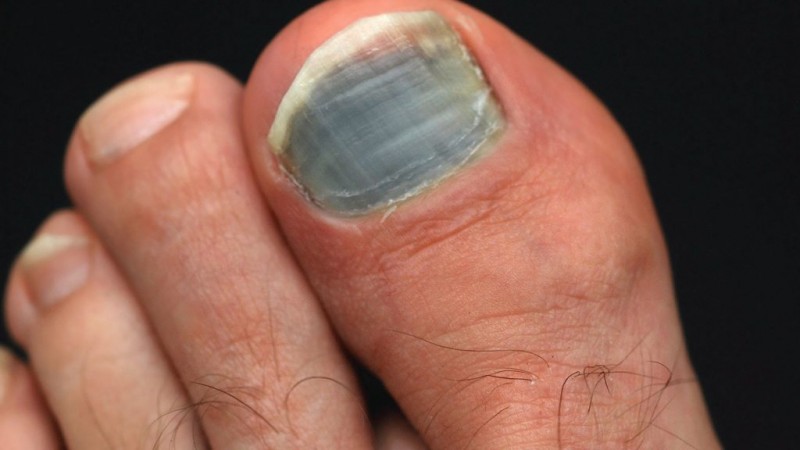 Причины, почему чернеют ногти на ногах у женщин. Как лечить ногти