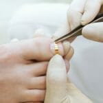 Протезирование ногтей на ногах: что это такое, как проходит процедура?