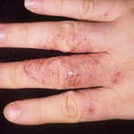 Кожные заболевания на пальцах рук: фото и названия
