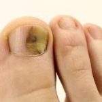 Как вылечить грибок на ногте большого пальца ноги?