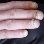 Ониходистрофия ногтей: лечение и причины заболевания у женщин и мужчин