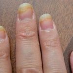 Как избавиться от грибка ногтей: лечение без таблеток и эффективными препаратами