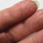 Лопается кожа на пальцах рук возле ногтей: причины и лечение