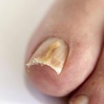 Чем лечить грибок ногтей на ногах в запущенной стадии?