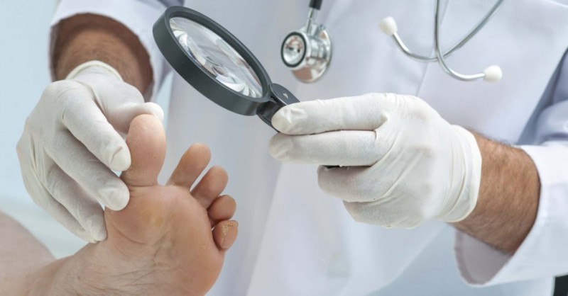 Причины появления трещин между пальцами ног и их лечение