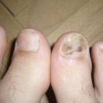 Как лечить синяк под ногтем на ноге?