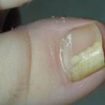 Дрожжевой грибок на ногтях и коже: причины и лечение