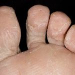 Как выглядит грибок на ногах: симптомы и лечение микоза стоп