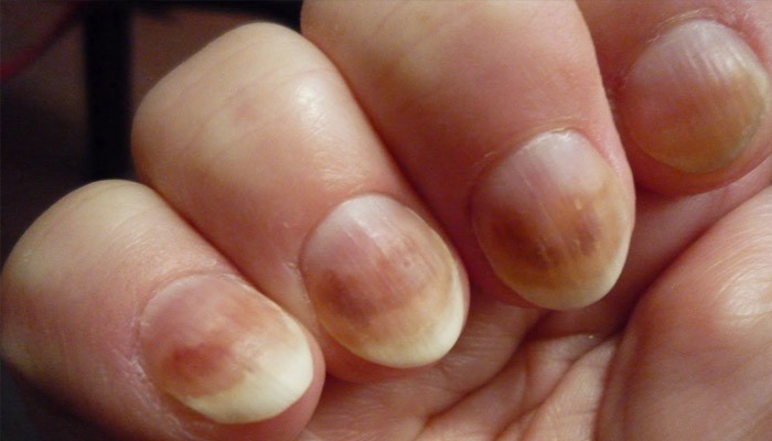Дрожжевой грибок на ногтях фото, лечение, виды и причины