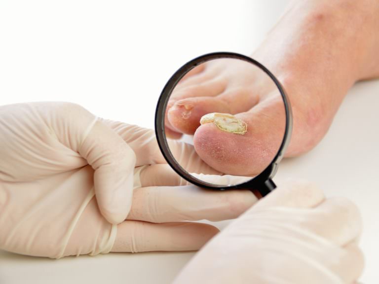 Какие опасности могут возникнуть в случае несвоевременного лечения грибка ногтей