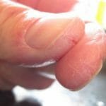 У ребенка трескается кожа на пальцах рук: причины и лечение
