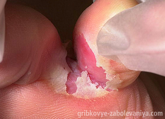 Как использовать Ламизил для лечения грибка ногтей