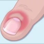 Грибок кандида на ногтях: фото, симптомы и лечение