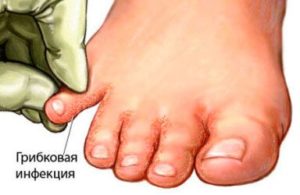 Признаки, лечение и профилактика грибкового заболевания на ногах при беременности