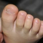 Лечение грибка ногтей у детей: медикаменты и народные средства