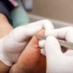 Шелушение кожи на стопах ног: причины и лечение