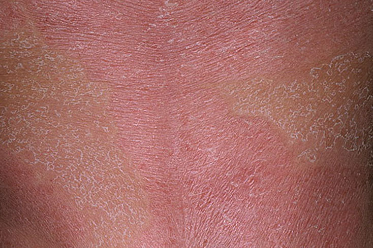 Тяжёлая форма хронического заболевания кожи