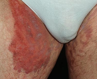 Микотические поражения кожи и слизистых оболочек