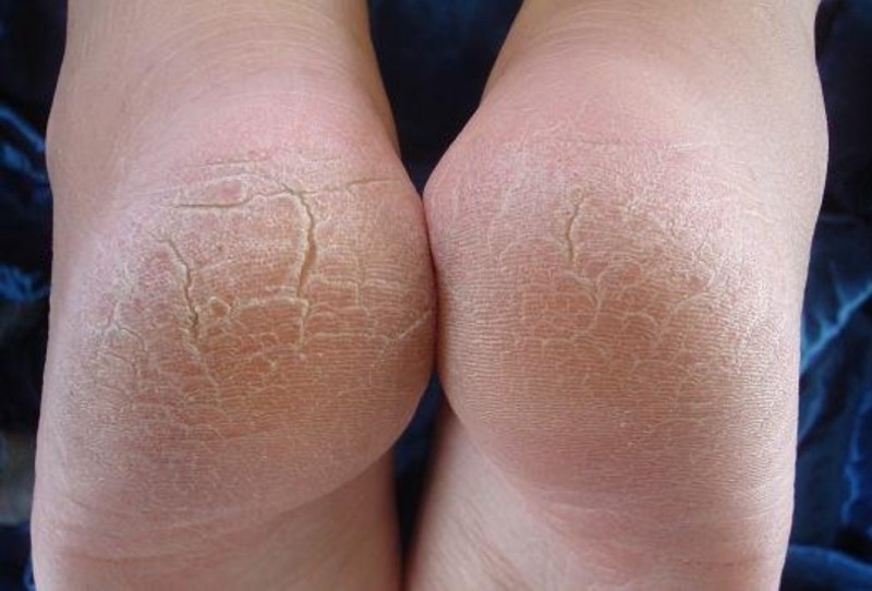 Трещины на пальцах ног причины и лечение