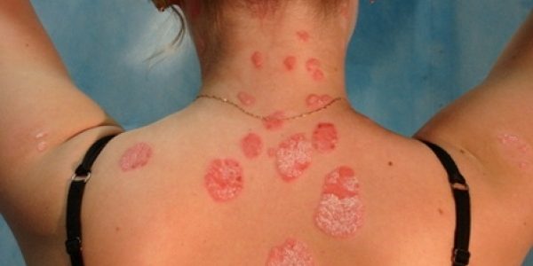 Псориаз и аллергия. Почему исключение аллергенов способствует скорейшему лечению псориаза